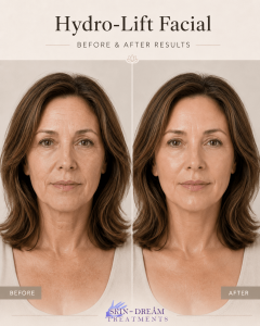 BEFORE & AFTER HYDRO GLOW (2) (1)