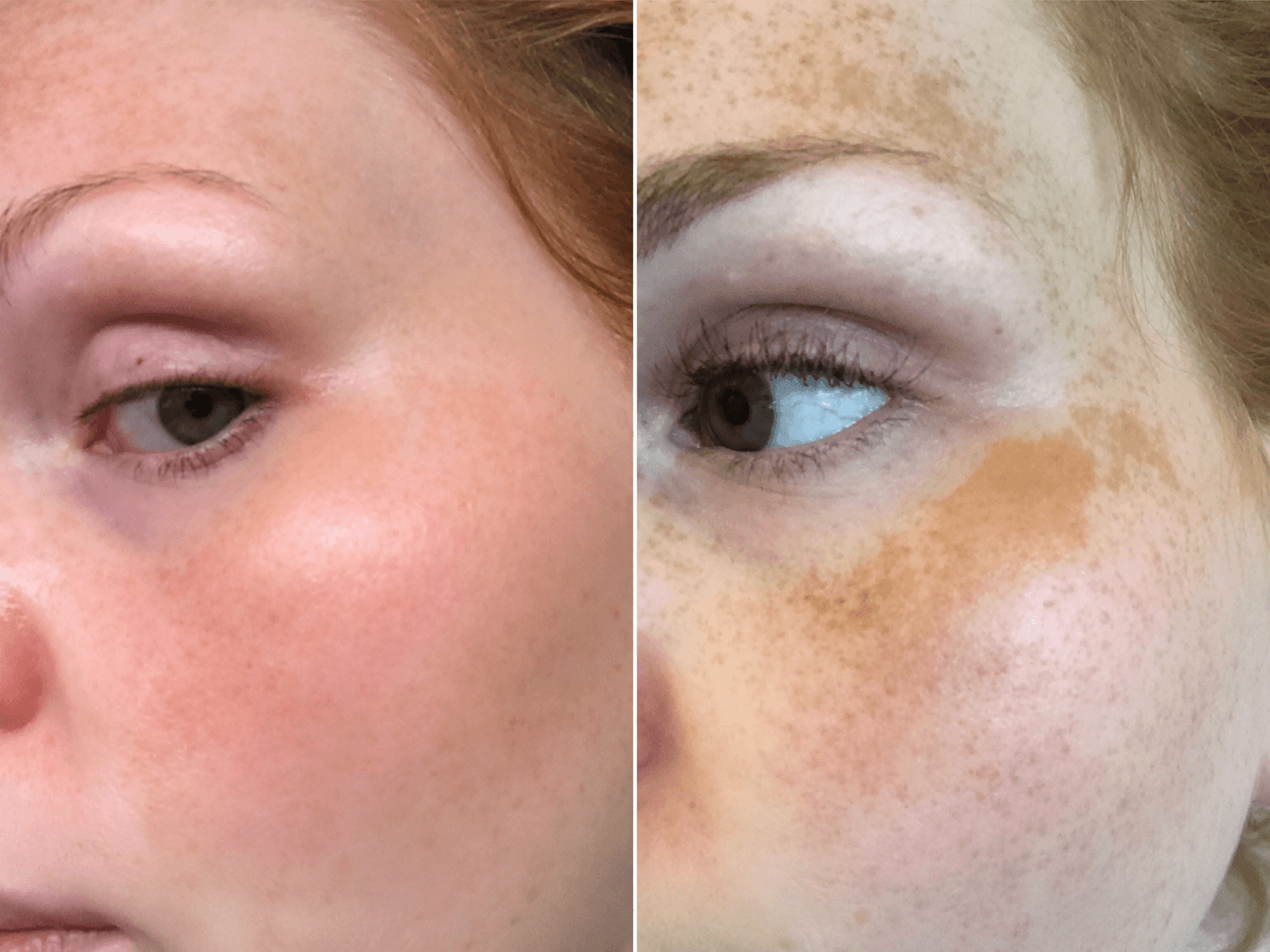 Chemical Peel PRX-T33 Before and After Example 4