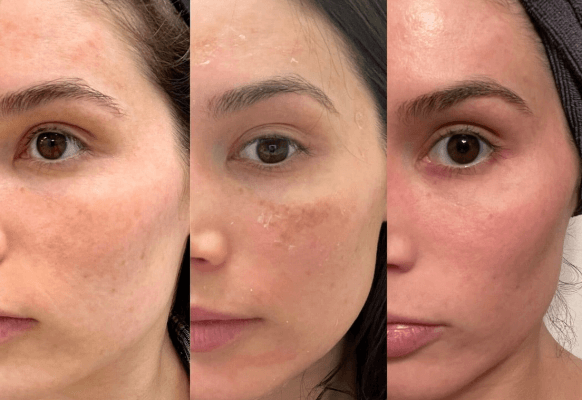 Chemical Peel PRX-T33 Before and After Example 3