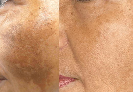 Chemical Peel PRX-T33 Before and After Example 2