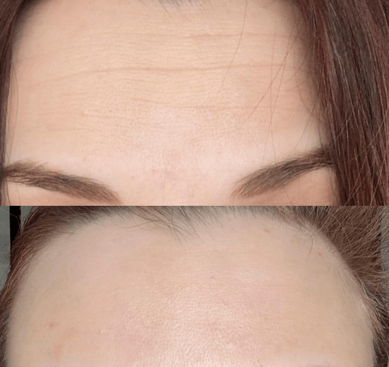 Chemical Peel PRX-T33 Before and After Example 1