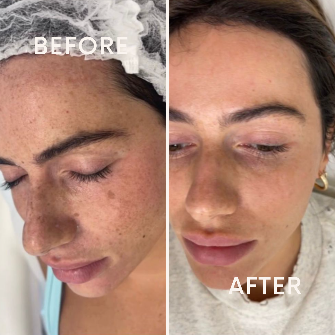 Neck Lift + Jawline Lift facial treatment Before and After Example 5