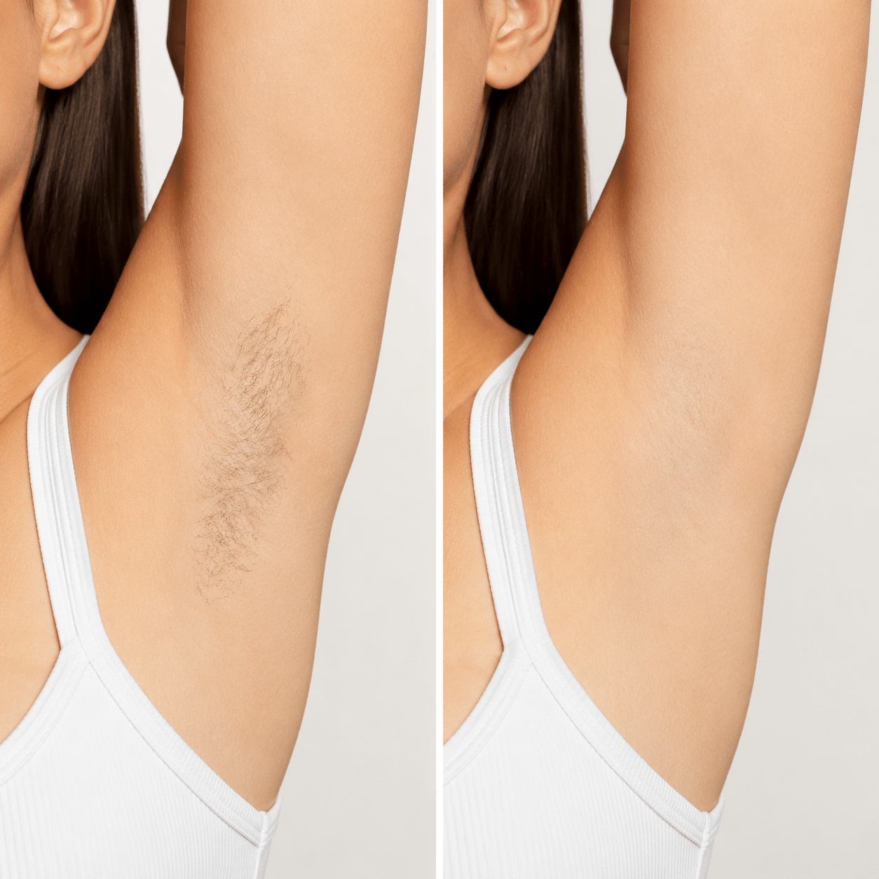 Laser Hair Removal Before and After Example 5