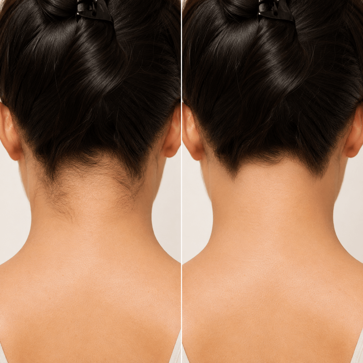 Laser Hair Removal Before and After Example 1
