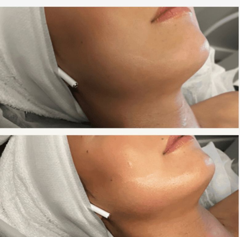 Neck Lift + Jawline Lift facial treatment Before and After Example 4