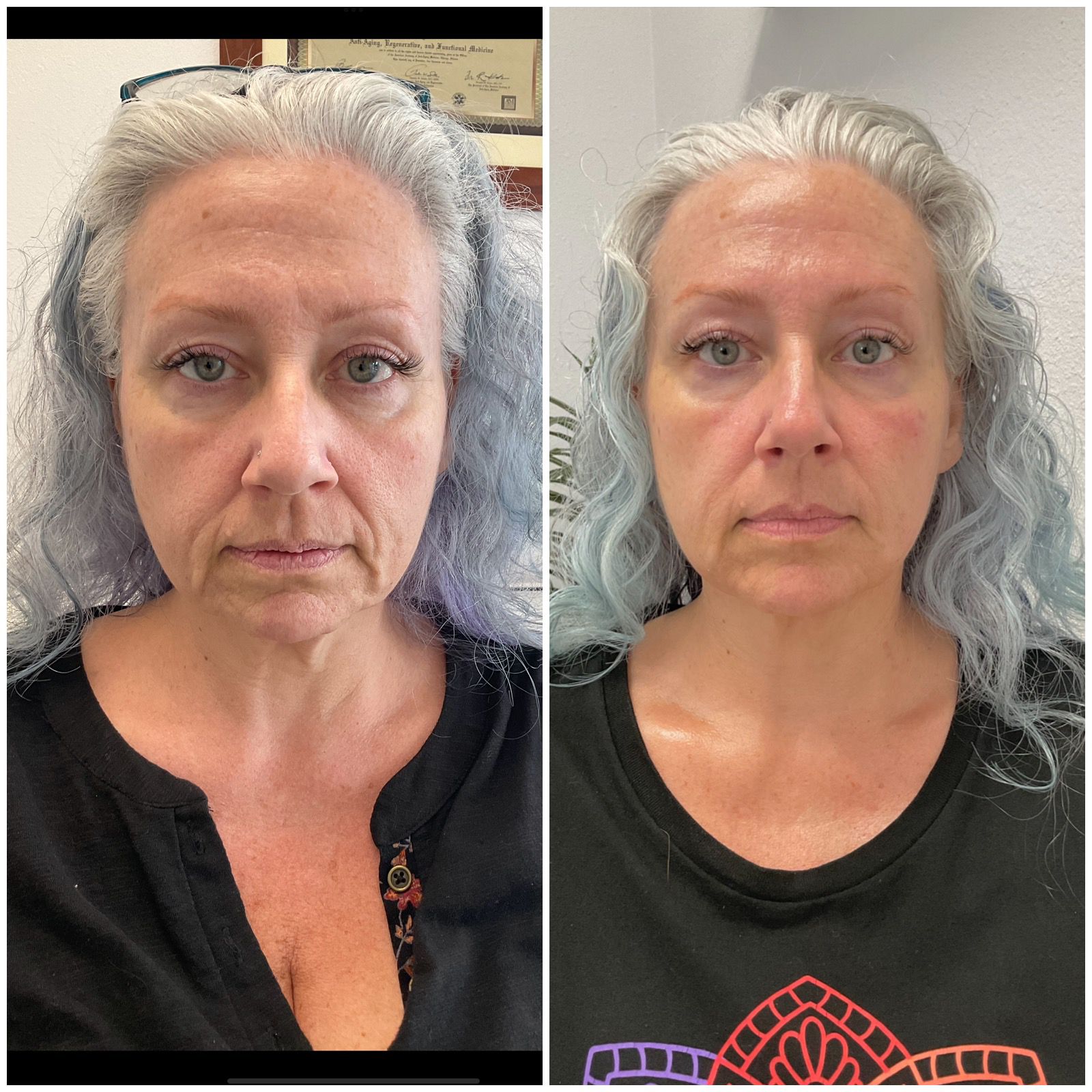 Neck Lift + Jawline Lift facial treatment Before and After Example 7