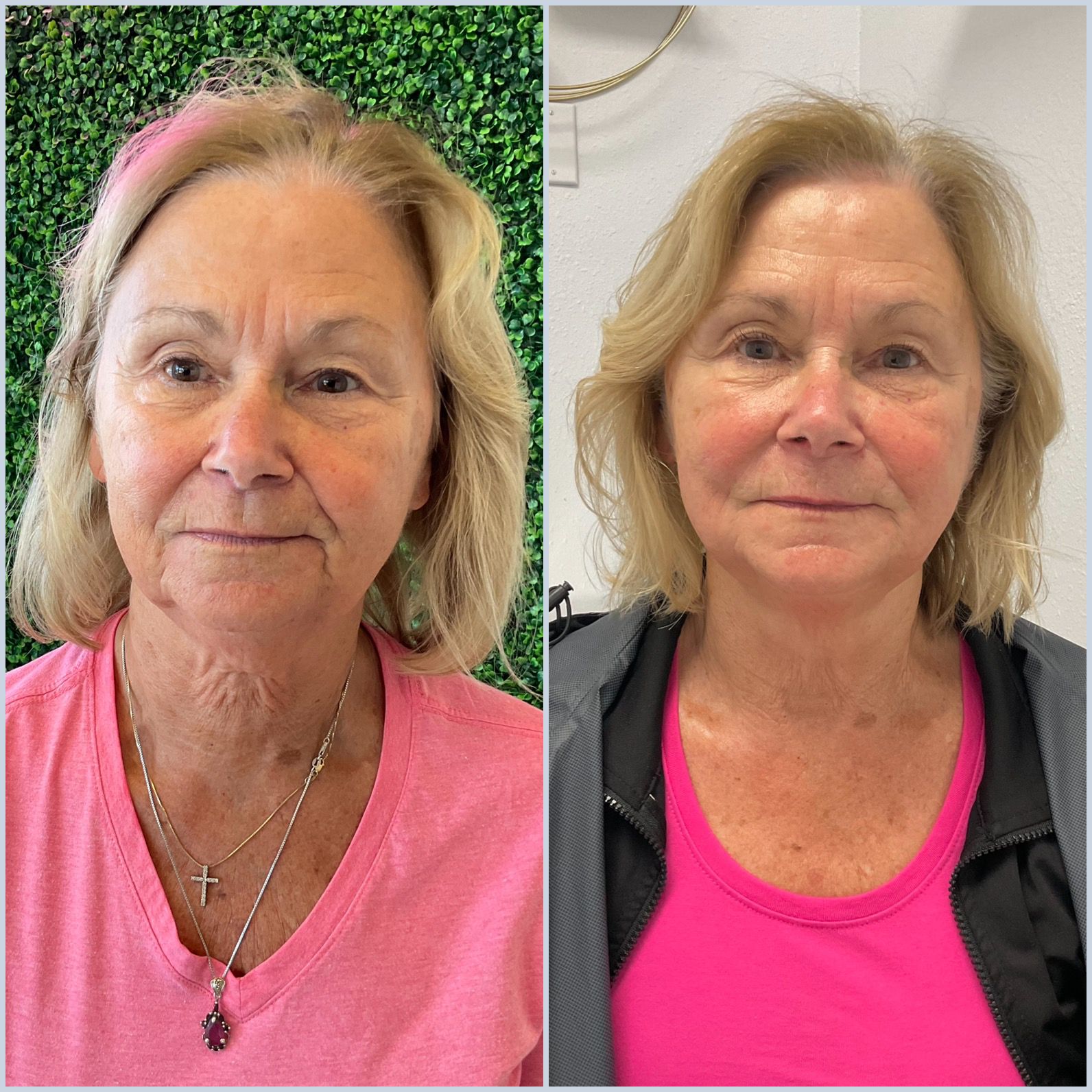Neck Lift + Jawline Lift facial treatment Before and After Example 6